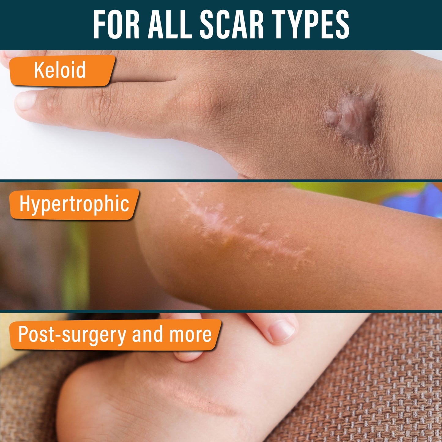NUVADERMIS Silicone Scar Sheets - Extra Long Scar Sheets for C-Section, Tummy Tuck, Keloid, and Surgical Scars - Reusable Medical Grade Silicone Scar Sheets - Pack of 4 - Light Tone