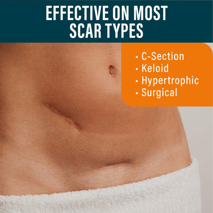 NUVADERMIS Silicone Scar Sheets - Extra Long Scar Sheets for C-Section, Tummy Tuck, Keloid, and Surgical Scars - Reusable Medical Grade Silicone Scar Sheets - Pack of 4 - Light Tone
