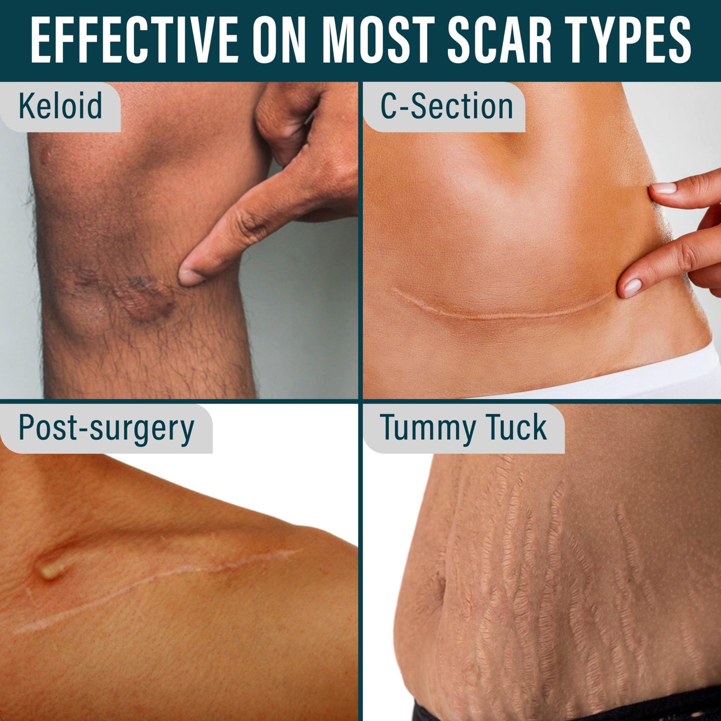 NUVADERMIS Silicone Scar Sheets - Extra Long Scar Sheets for C-Section, Tummy Tuck, Keloid, and Surgical Scars - Reusable Medical Grade Silicone Scar Sheets - Pack of 4 - Light Tone