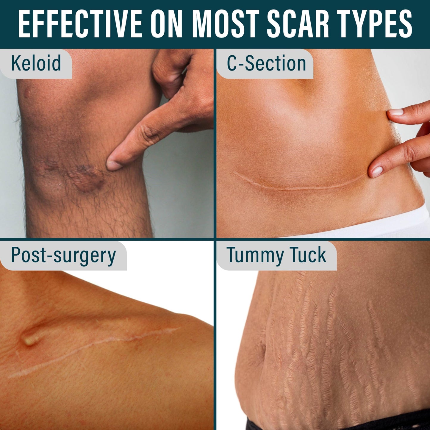 NUVADERMIS Silicone Scar Sheets - Extra Long Scar Sheets for C-Section, Tummy Tuck, Keloid, and Surgical Scars - Reusable Medical Grade Silicone Scar Sheets - Pack of 4 - Light Tone