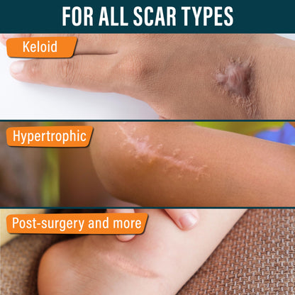NUVADERMIS Silicone Scar Sheets - Extra Long Scar Sheets for C-Section, Tummy Tuck, Keloid, and Surgical Scars - Reusable Medical Grade Silicone Scar Sheets - Pack of 4 - Light Tone